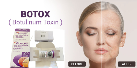 100Unit Allergan Botulinum Toxin Tipe A Injeksi Untuk Menghilangkan Kerut Wajah