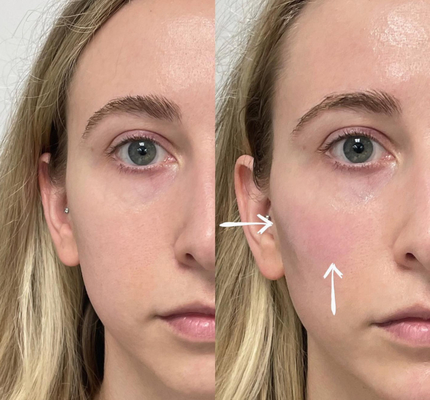 Skinject Deep Hyaluronic Acid Dermal 2ml Pengisi Bibir Suntik