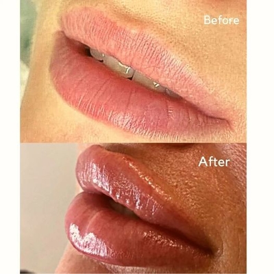 Injeksi Pengisi Injeksi Juvederms Ultra 3 HA Dermal Filler Untuk Volume Bibir