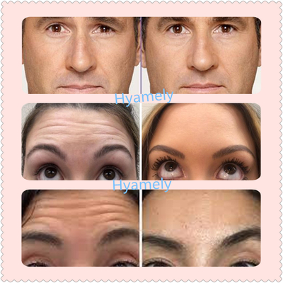Turki Allergan  100 IU Botulinum Toxin Tahan Lama
