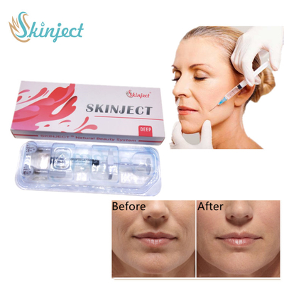 Pengisi Bibir Dermal Injeksi Untuk Keriput Dan Lipatan Wajah Yang Dalam