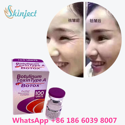 Botulinum Toxin  Wrinkle Removal 100u Allergan 100 Unit Untuk Injeksi Pengangkatan Wajah