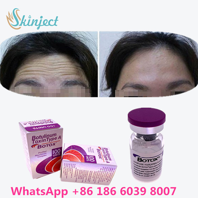 Botulinum Toxin  Wrinkle Removal 100u Allergan 100 Unit Untuk Injeksi Pengangkatan Wajah