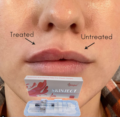 Injectable Deep Hyaluronic Acid Dermal 2ml Lip Filler Pipi Dagu Lipatan Nasolabial