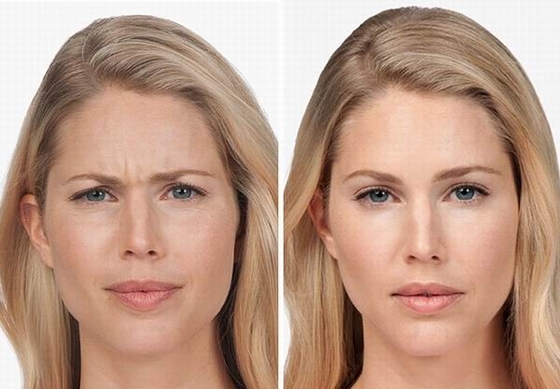 100 Iu Produk Anti Kerut Korea Botulinum Toxin  Tipe A
