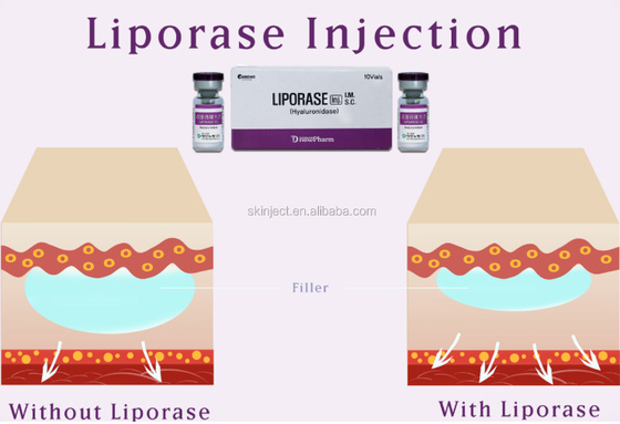10 Vias Liporase Hyaluronidase Untuk Dermal Filler Untuk Larut