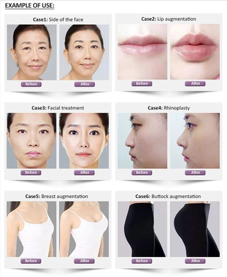 1.1ml Revolax Deep Hyaluronic Dermal Filler Untuk Wajah