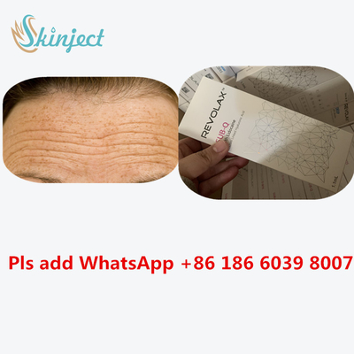 Suntikan Pengisi Dalam Revolax Tautan Silang Sub-Q Wajah Asam Hyaluronic