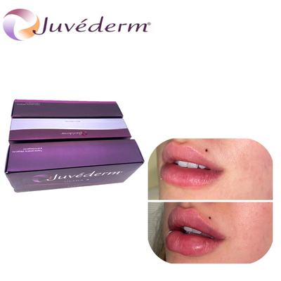 Injeksi Dermal Filler Ultra3 Ultra4 Voluma Untuk Bibir Tulang Pipi