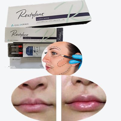 Cross Linked Hyaluronic Acid Dermal Filler Untuk Peningkatan Bibir Payudara
