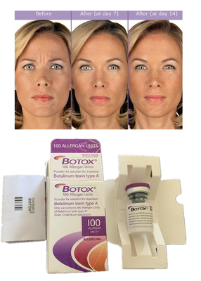 Injeksi Allergan Botulinum Toxin 100IU Anti Wrinkle Filler Kulit