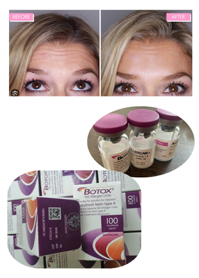 Anti Kerutan Botulinum Toxin Allergan 100IU 150iu  Injeksi  'Na