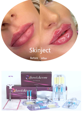 Juvederm Hyaluronic Acid Facial Dermal Filler Injeksi 2*1ml Packing
