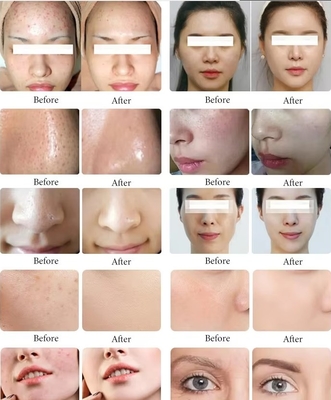 Baru Datang Black Pearl 10 In 1 Hydra Peel Machine Microdermabrasion Machine Facial Spa Micro-Touch Hydra Perawatan Kulit