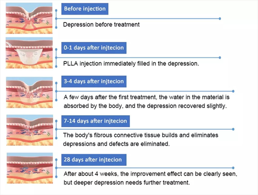PLLA Poly- L- Lactic Acid Injeksi Wajah 10 Vial 150mg