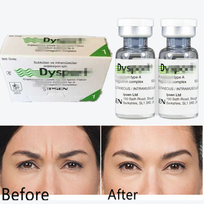 Botulinum Toxin Dysport Powder Anti-Wrinkle Powder Freeze-Dried Powder Untuk Glabella