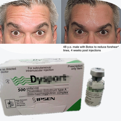 Botulinum Toxin Dysport Powder Anti-Wrinkle Powder Freeze-Dried Powder Untuk Glabella