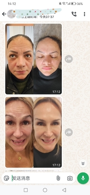 Dysport Kosmetik 500 Unit Botulinum Toxin 500 IU Powder Untuk Injeksi