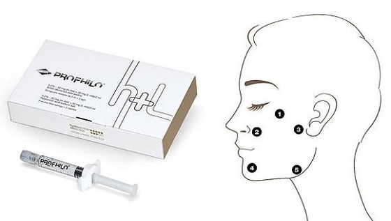 Stimulasi Kolagen Profhilo Filler Kulit Injeksi Lima Titik Lifting