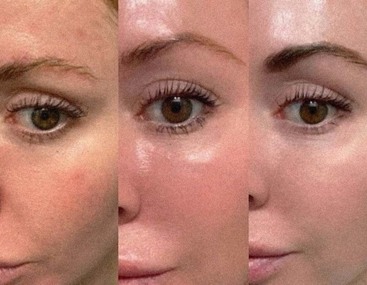 Stimulasi Kolagen Profhilo Filler Kulit Injeksi Lima Titik Lifting