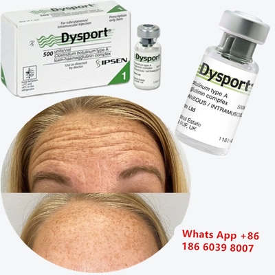 Toksin Botulinum Tipe A Dysport untuk Kerutan Tear Trough