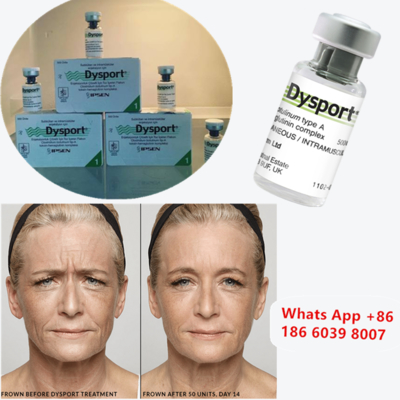 Dysport 500u Botulinum Toxin Tipe A untuk Pembesaran pipi