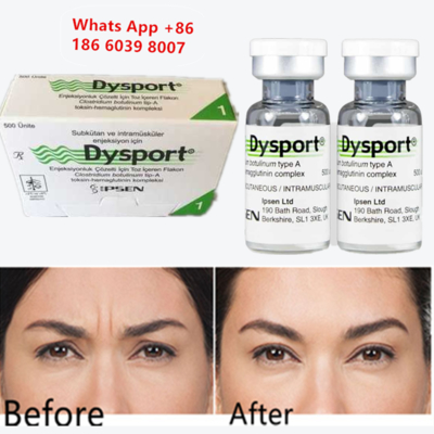 Botulinum Toxin Tipe A Disport Injeksi untuk Pengurangan Kerutan