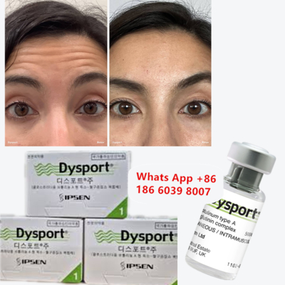 Toksin Botulinum Tipe A Dysport untuk Garis Kerutan dan Glabella