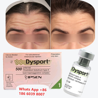 Suntikan Anti-Kerut Toksin Botulinum Tipe A Dysport untuk Garis Perioral