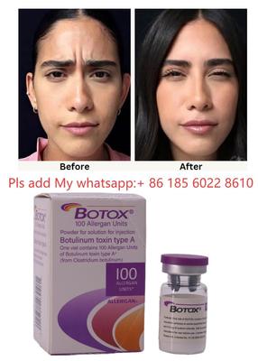 Suntikan Botox ALLERGAN Toksin Botulinum Tipe A