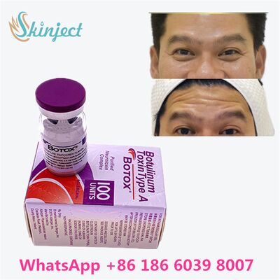 Toksin Botulinum ALLERGAN BOTOX Durasi 4 hingga 6 Bulan 100 Unit Tipe A