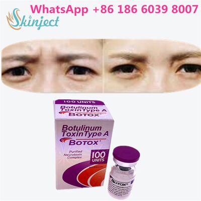 Toksin Botulinum ALLERGAN BOTOX Durasi 4 hingga 6 Bulan 100 Unit Tipe A
