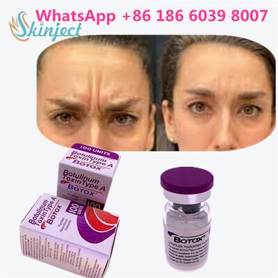 Botulinum Toxin Tipe A Botox Allergan Yang Dirancang Untuk Penggunaan Medis dan Kosmetik