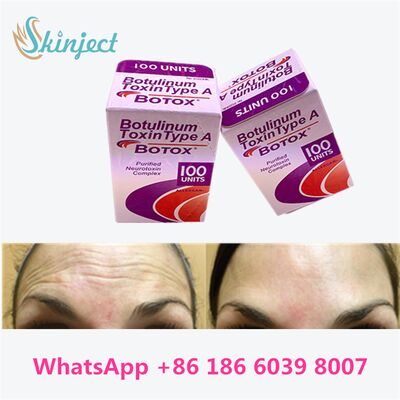 Botox Allergan Botulinum Toxin Tipe A 100 Unit untuk Menghilangkan Kerutan dengan Durasi 4~6 Bulan