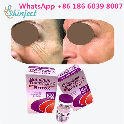 Botox Allergan Botulinum Toxin Tipe A 100 Unit untuk Menghilangkan Kerutan dengan Durasi 4~6 Bulan