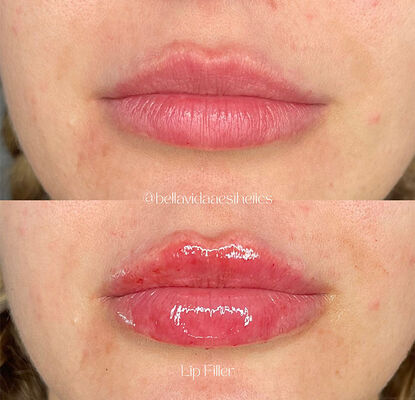 Daya simpan 2 tahun gel injeksi filler dermal yang dirancang untuk pengurangan kerutan, kontur wajah, dan revitalisasi kulit