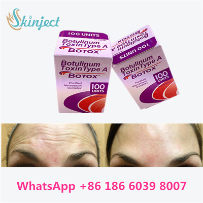 Botulinum Toxin Allergan BOTOX Injeksi Kosmetik 100 Unit untuk Glabellar lines