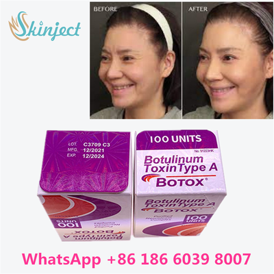 Botulinum Toxin Allergan BOTOX Injeksi Kosmetik 100 Unit untuk Glabellar lines