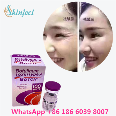 Botulinum Toxin Allergan Botox White Powder Pengobatan Efektif untuk Garis Wajah dan Relaksasi Otot di Medis