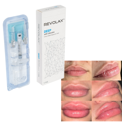 Revolax Hyaluronic Acid Dermal Filler Natural Plump Lip Augmentation Pemulihan Volume Wajah