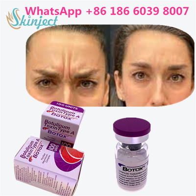 Toksin Botulinum BOTOX Kosmetik 100 Unit Allergan OnabotulinumtoxinA untuk Kerutan Wajah