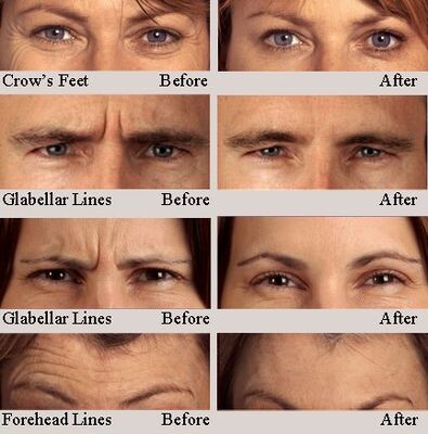 Hyamely Premium Botulinum Toxin Tipe A untuk Injeksi