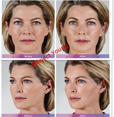 Juvederm Voluma 2x1ml Pengisi Gel Suntik Asam Hyaluronic