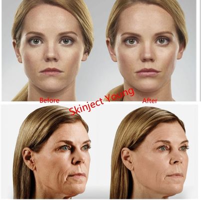 Juvederm Voluma 2x1ml Pengisi Gel Suntik Asam Hyaluronic