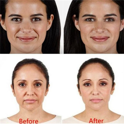 Juvaderm Voluma Hyaluronic Acid Pen Filler Untuk Kerutan Dahi Mata