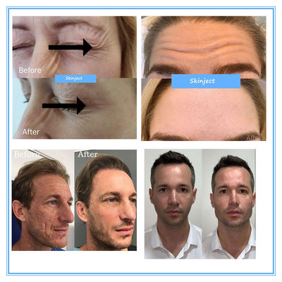 Hyamely Botax Injeksi Penghapusan Kerut 100 Unit Botulinum Toxin Beauty