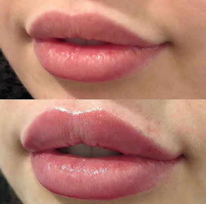 Russian Lips Juvederm Ultra 3 Dengan  Cross Linked Dermal Filler
