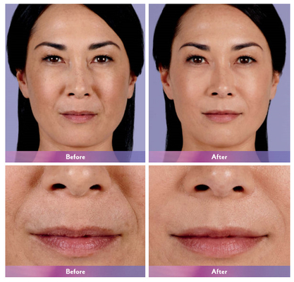Juvederm Dermal Filler Injeksi Bibir Ultra 4 Untuk Pembesaran Bibir