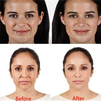 HA 2ml Dermal Filler Suntikan Bibir Pengisi Kerut Suntik Juvederm