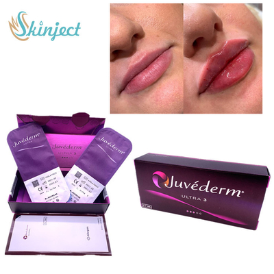 Nasolabial Lips Bibir 2x1ml Dermal Filler Asam Hyaluronic Juvederm Ultra3